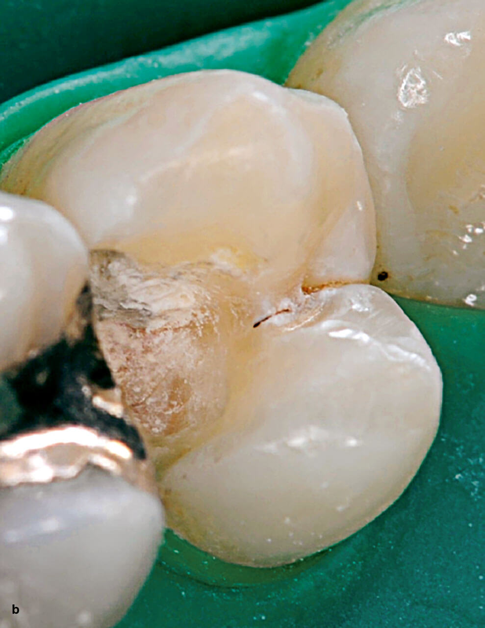 Abb. 8b Zahn nach direkter Überkappung mit einem Di- und Trikalziumsilikat­zement (Biodentine,  Septodont).