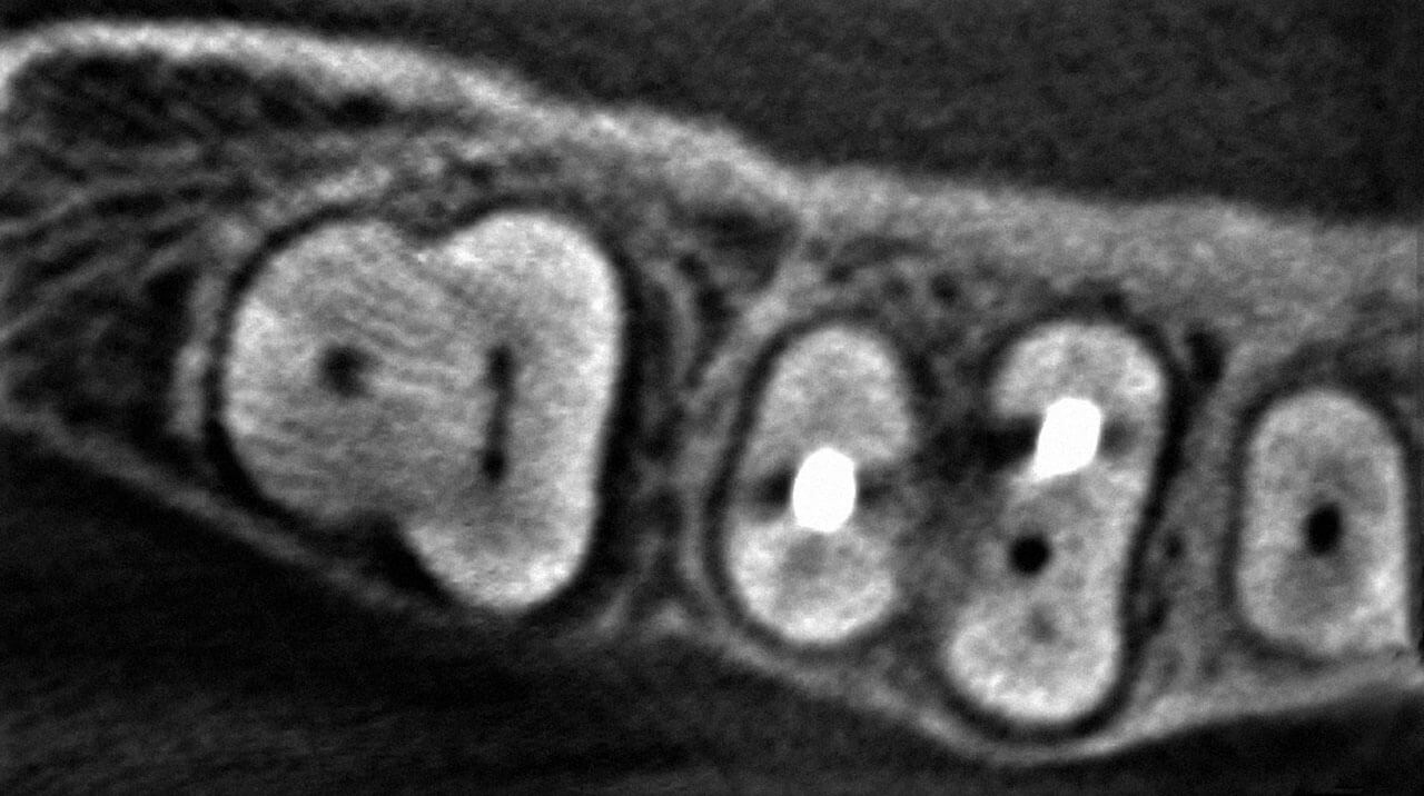 Abb. 6 DVT, axiale Ansicht der Regio 46: Der mesio­bukkale Wurzelkanal ist in dieser Schicht deutlich zu erkennen. 