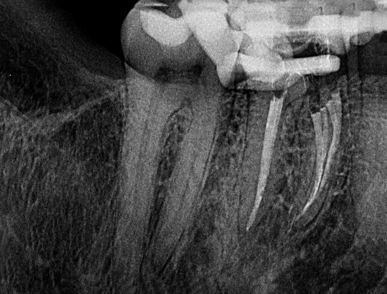 Abb. 11 Radiologische Kontrolle der Wurzelkanalfüllung in distalexzentrischer Projektion.