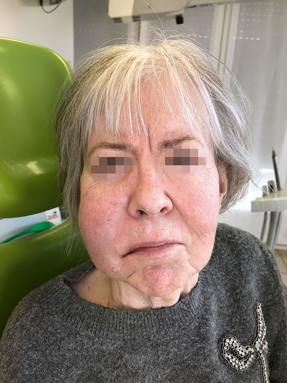 Abb. 1 Spülunfall bei einer weiblichen Patientin nach endodon­tischer Behandlung der Zähne 12 und 13 alio loco. Extraorale Schwellung direkt nach der Spülung mit NaOCl 6 Prozent und einer TruNatomy Spülkanüle (Dentsply Sirona).