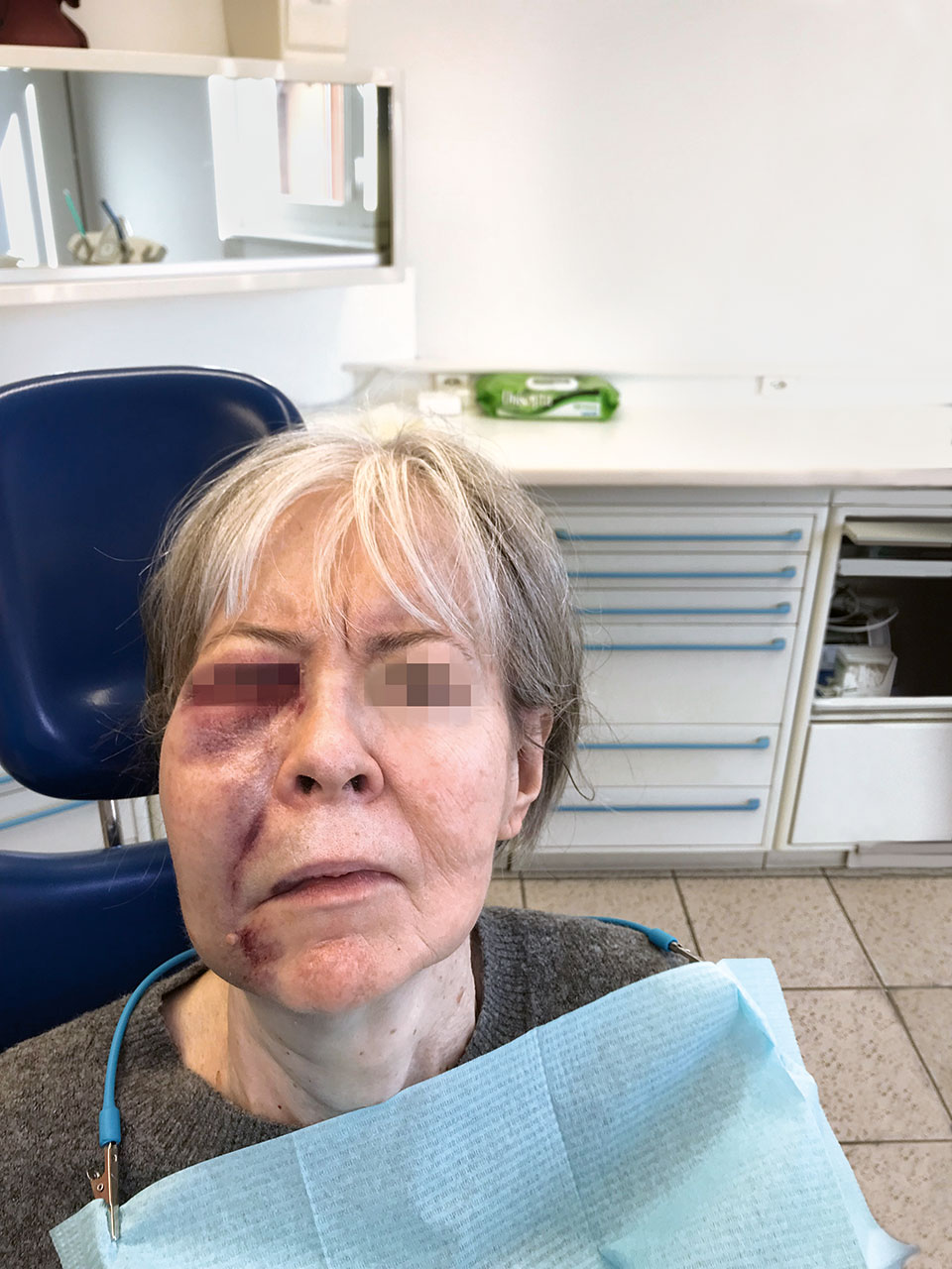 Abb. 2 Schwellung und Hämatom periorbital und perioral rechts zwei Tage nach dem Spülunfall.