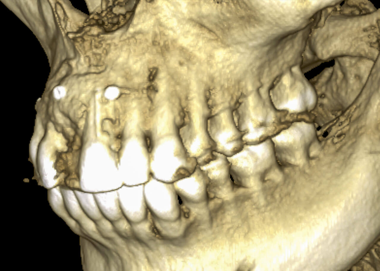 Abb. 7 Digitale Volumentomografie: Im distalen Wurzelbereich des Zahnes 21 sind bereits deutliche Resorptionszeichen zu erkennen.