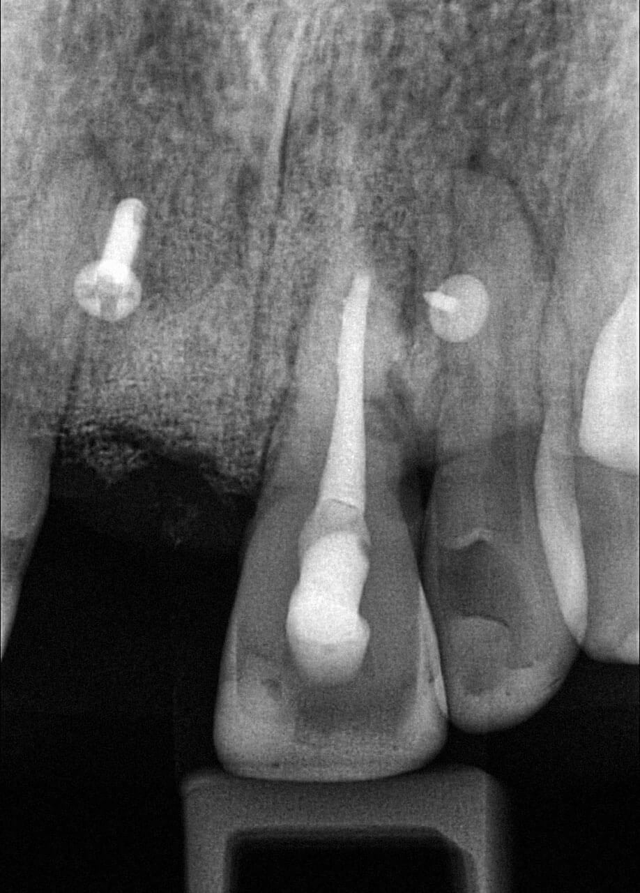 Abb. 9 Einzelzahnaufnahme Zahn 21: Im distalen Wurzelbereich sind deutliche Resorptionsvorgänge sichtbar.