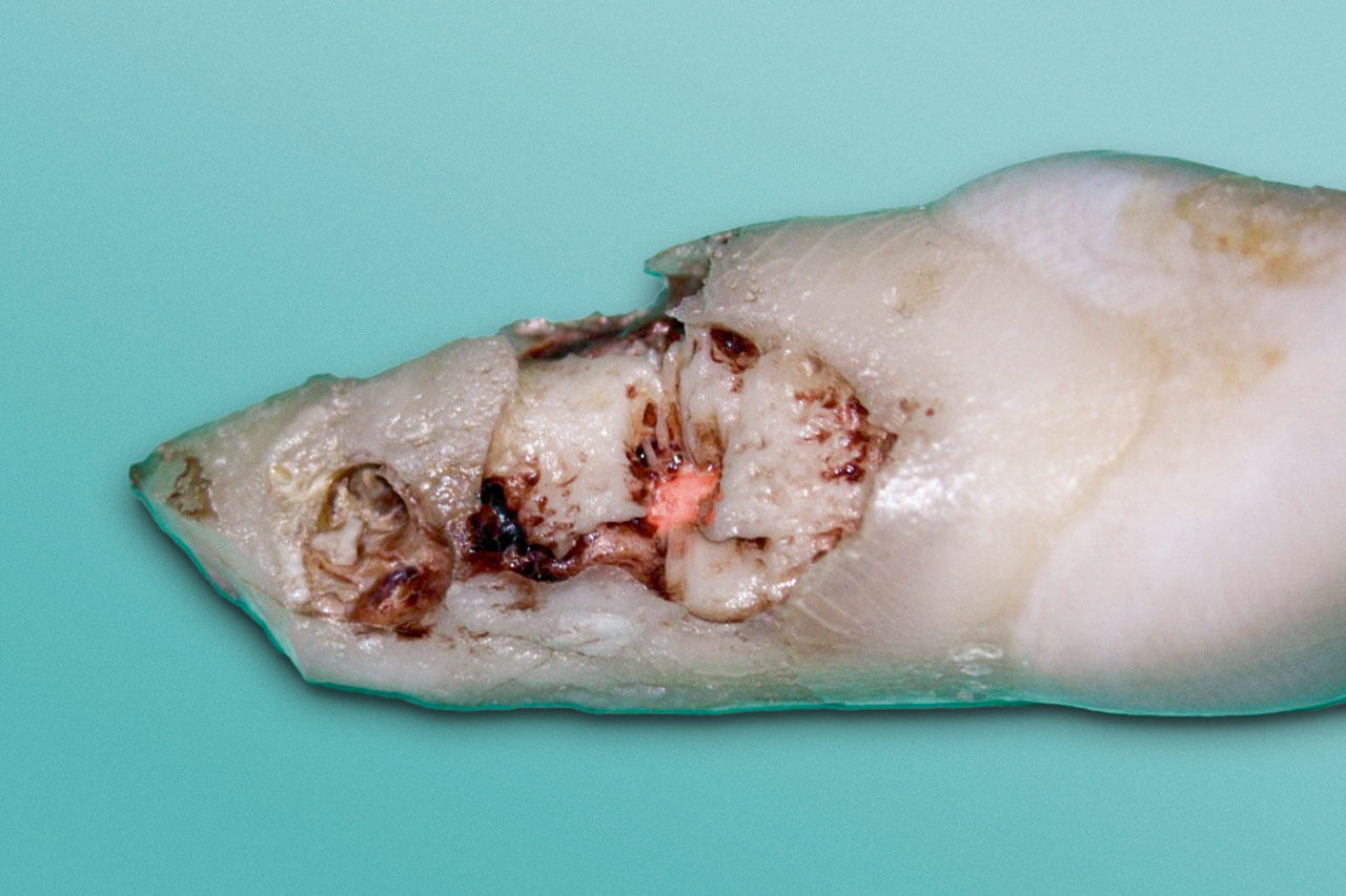 Abb. 10 Distale Wurzeloberfläche von Zahn 21 nach der Extraktion.