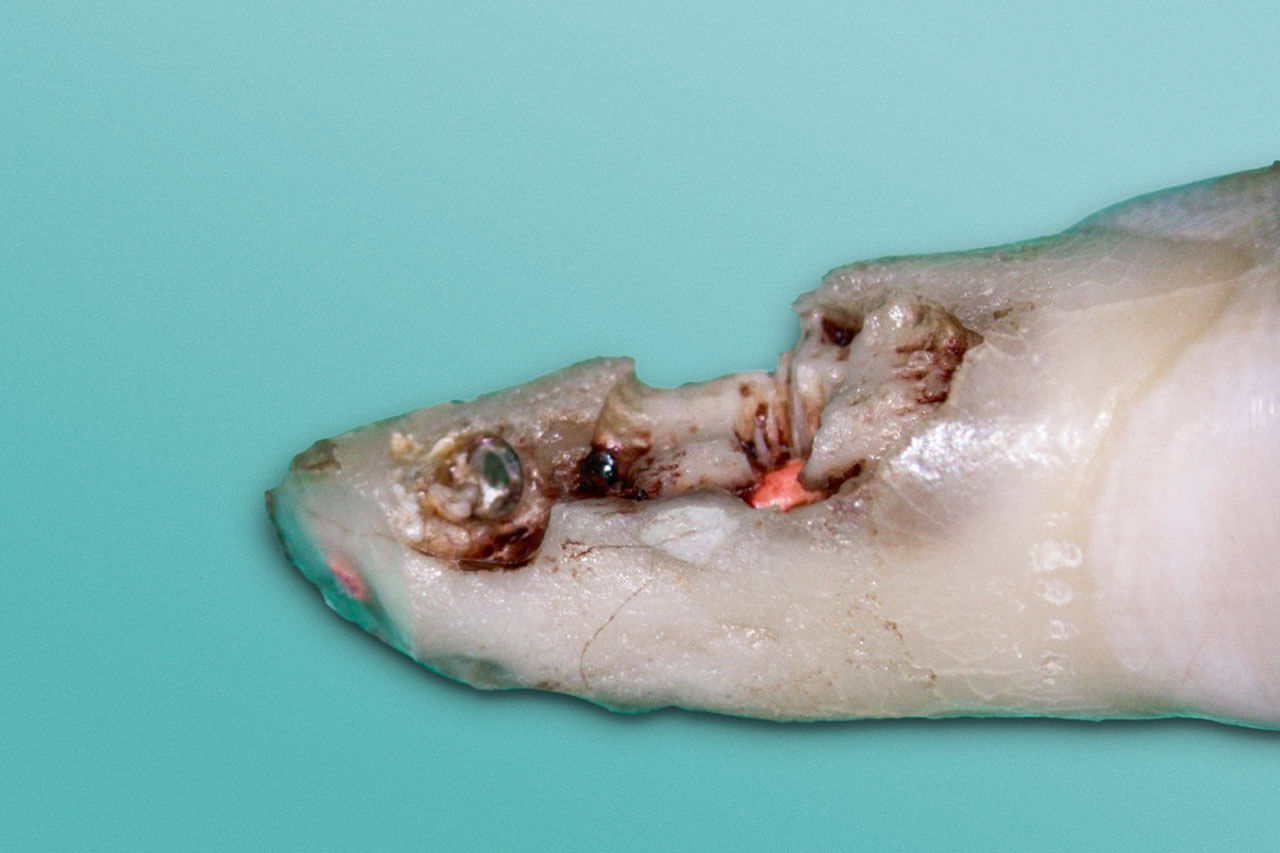 Abb. 11 Distobukkale Wurzeloberfläche von Zahn 21 nach der Extraktion.
