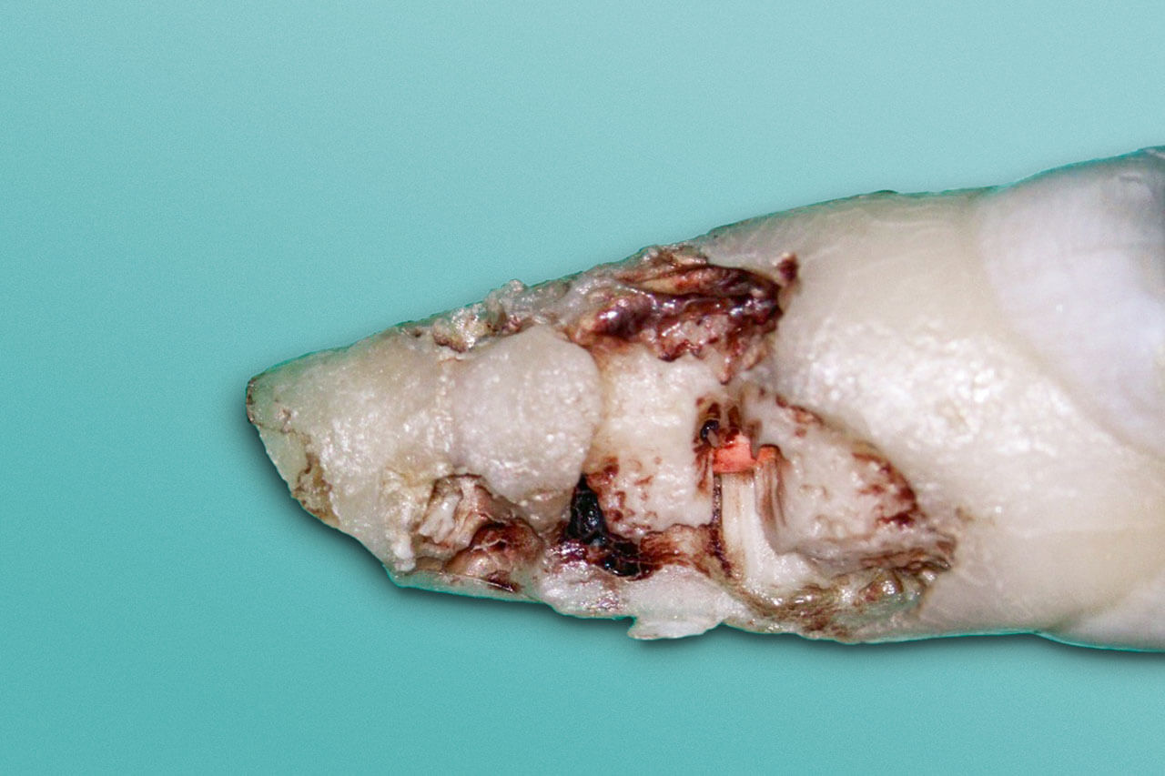 Abb. 12 Distopalatinale Wurzeloberfläche von Zahn 21 nach der Extraktion.