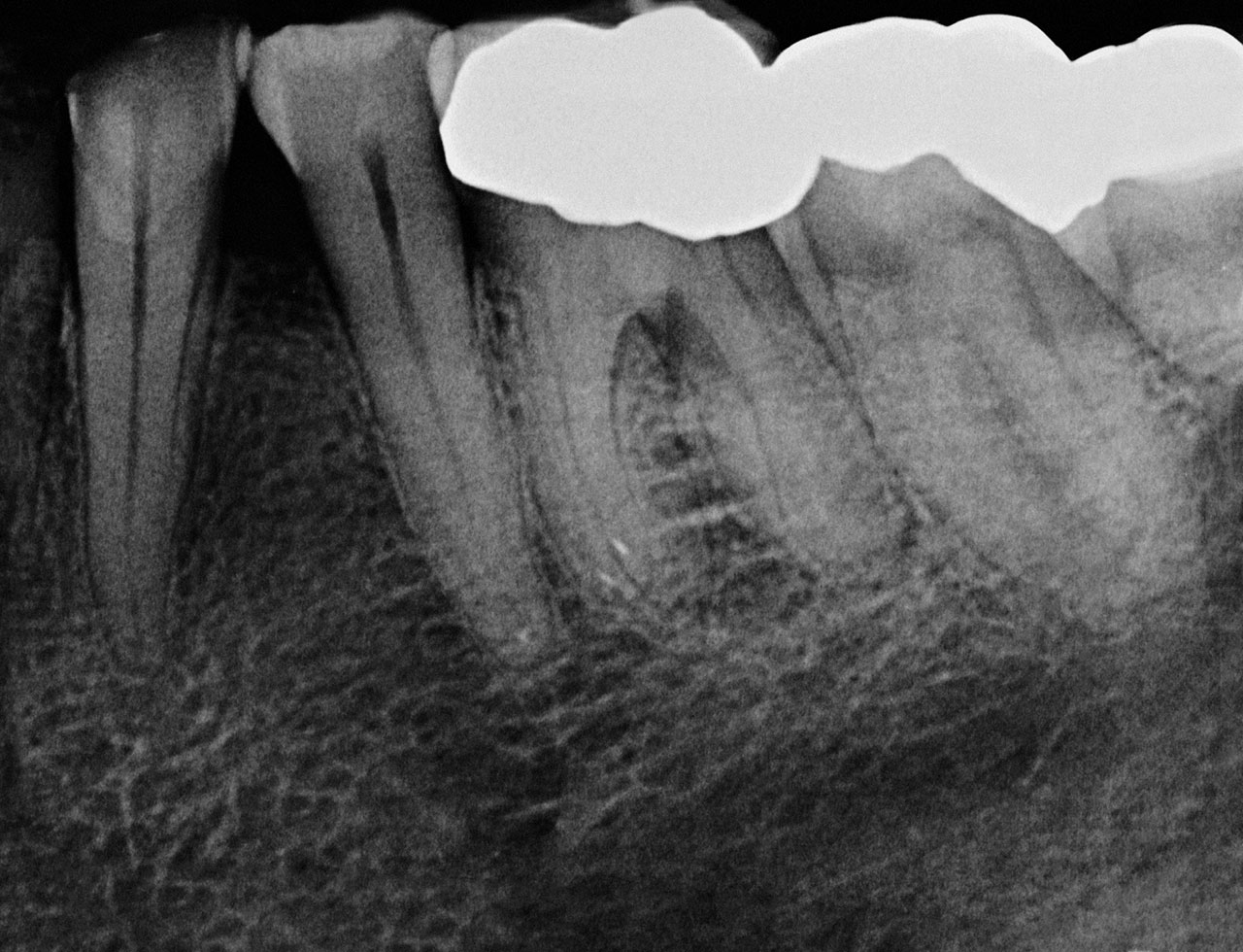 Abb. 2 Präoperatives Röntgenbild von Zahn 36. 