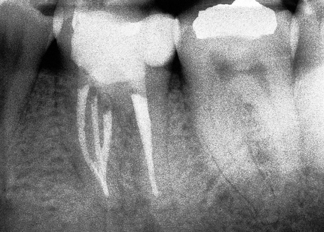 Abb. 8 „Middle mesial“ Konfiguration Typ II.