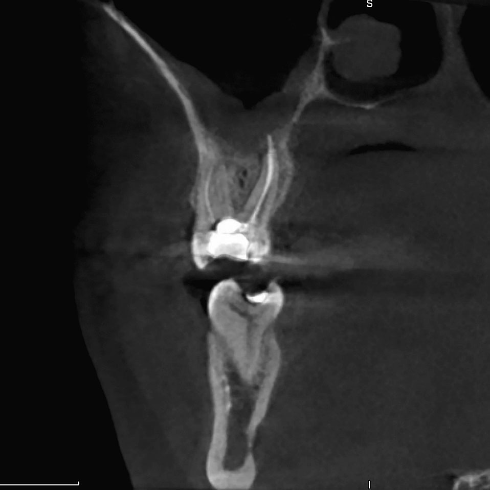Abb. 2 Basale OSM, ausgehend vom endodontisch insuffizient behandelten Zahn 16. Neben einem palatinal überstopften Guttaperchastift wurde ein unbehandelter Kanal mb2 radiologisch diagnostiziert. Anamnestisch berichtete der Patient über rezidivierende einseitige Sinusitiden, insbesondere in den Wintermonaten.