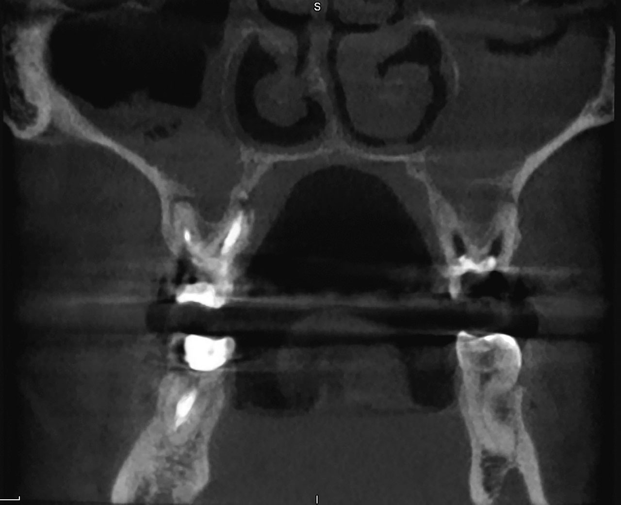 Abb. 3 Beidseitige OSM, ausgehend von apikalen Parodontitiden der Zähne 16 und 26. Anamnestisch wurde HNO-ärztlich eine persistierende CRS diagnostiziert und funktionell-­endoskopisch operiert, jedoch ohne Erfolg.
