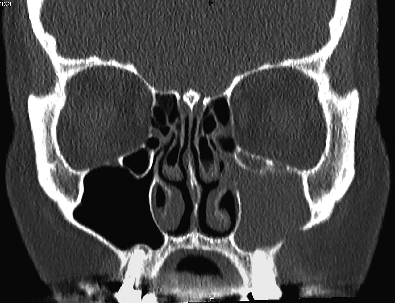 Abb. 4 Beidseits sind Conchae bullosae und Hallersche Zellen zu erkennen. Die Abbildung zeigt eine rezidivierende und persistierende postoperative OSM bei Zustand nach transoraler, osteoplastischer Entfernung eines Osteoms der linken Kieferhöhle.