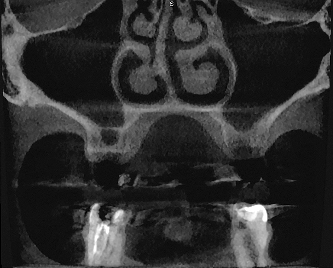 Abb. 6 Patient aus Abbildung 3: physiologische Verhältnisse nach Sanierung. Die Therapie beschränkte sich auf der rechten Seite auf eine Zahnextraktion mit plastischer MAV-Deckung. Auf der linken Seite war aufgrund eines Kieferhöhlenempyems zusätzlich eine transalveoläre Kieferhöhlenrevision erforderlich.