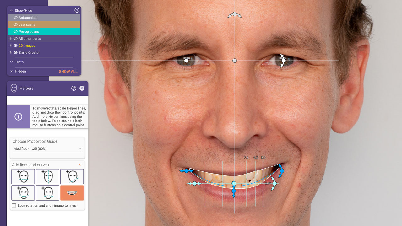 Abb. 1: Mit der neuen Version von DentalCAD 3.0 Galway führt exocad KI-Technologie für seinen Smile Creator ein. Gesichtsmerkmale wie die Lippenlinie oder die Augenposition werden automatisch erkannt, um das individuelle Smile Design zu unterstützen und zu beschleunigen.