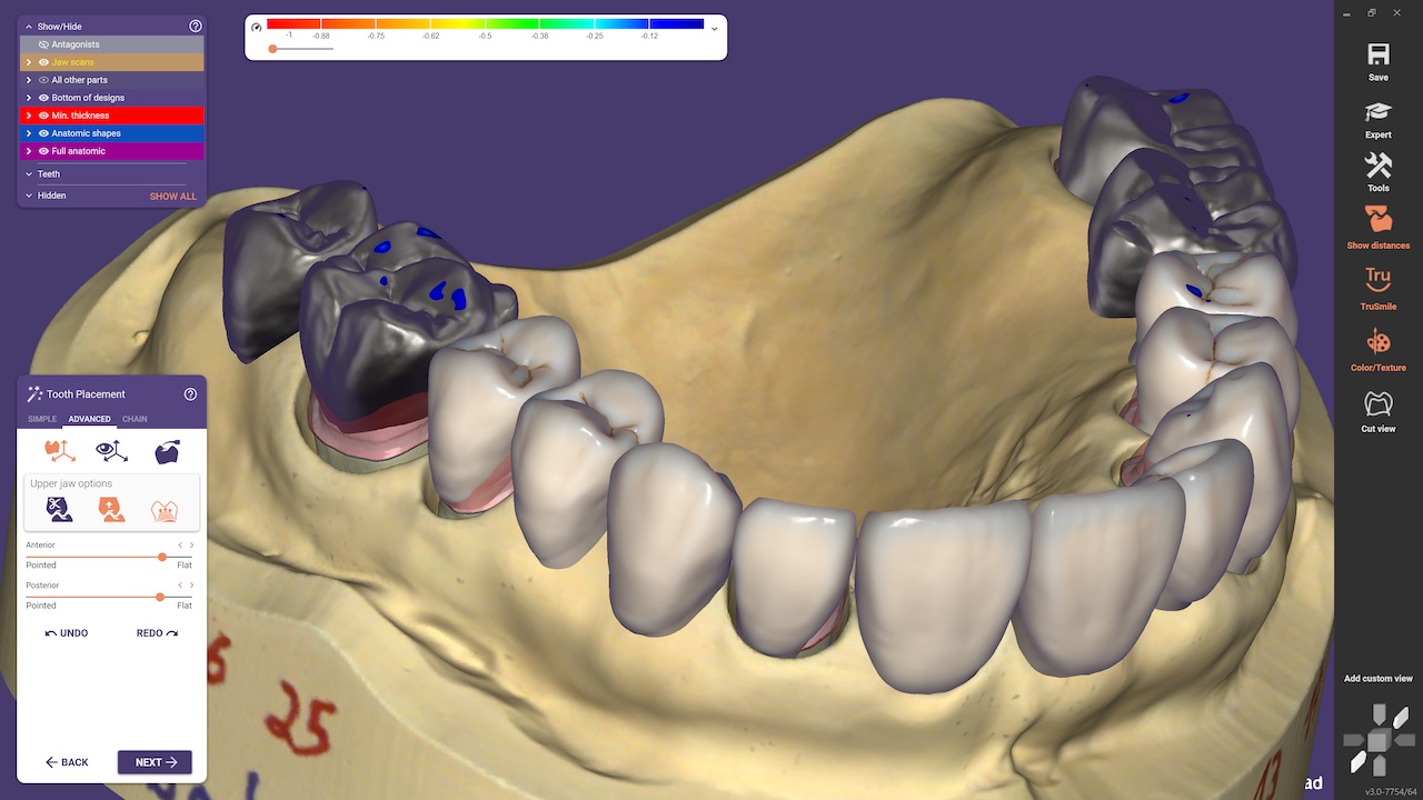 Abb. 5: Per Schieberegler wird die Abnutzung der Zähne angepasst, unabhängig der gewählten Zahnbibliothek.