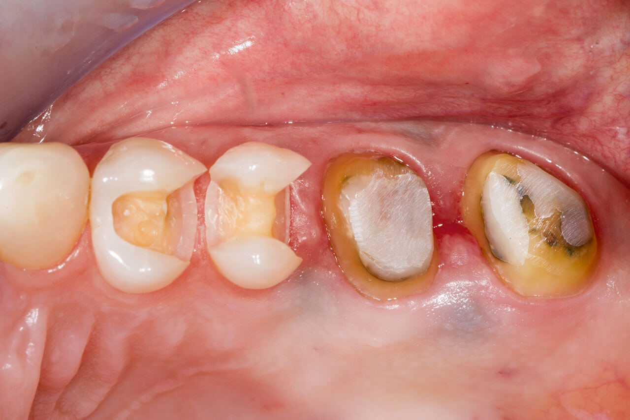 Abb. 3 Inlay-Präparationen an den Zähnen 24 und 25. Kronen-Präparationen an den Zähnen 26 und 27. Alle Zähne reagierten positiv auf CO2-Schnee.