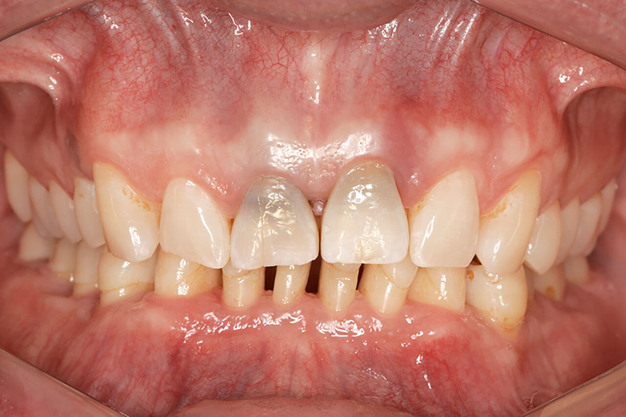 Abb. 2 Ausgangssituation: Frontalansicht mit ­retrahierten Lippen.
