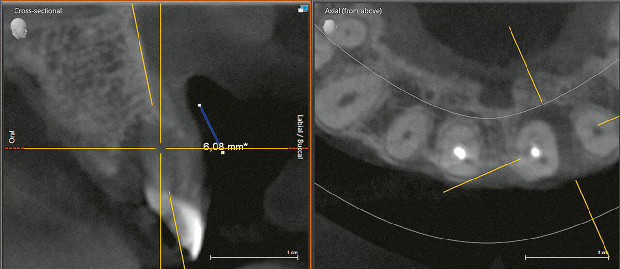 Abb. 5 Ausgangssituation, DVT-Schnittrekonstruktionen: Zahn 21, Darstellung der Knochentasche.