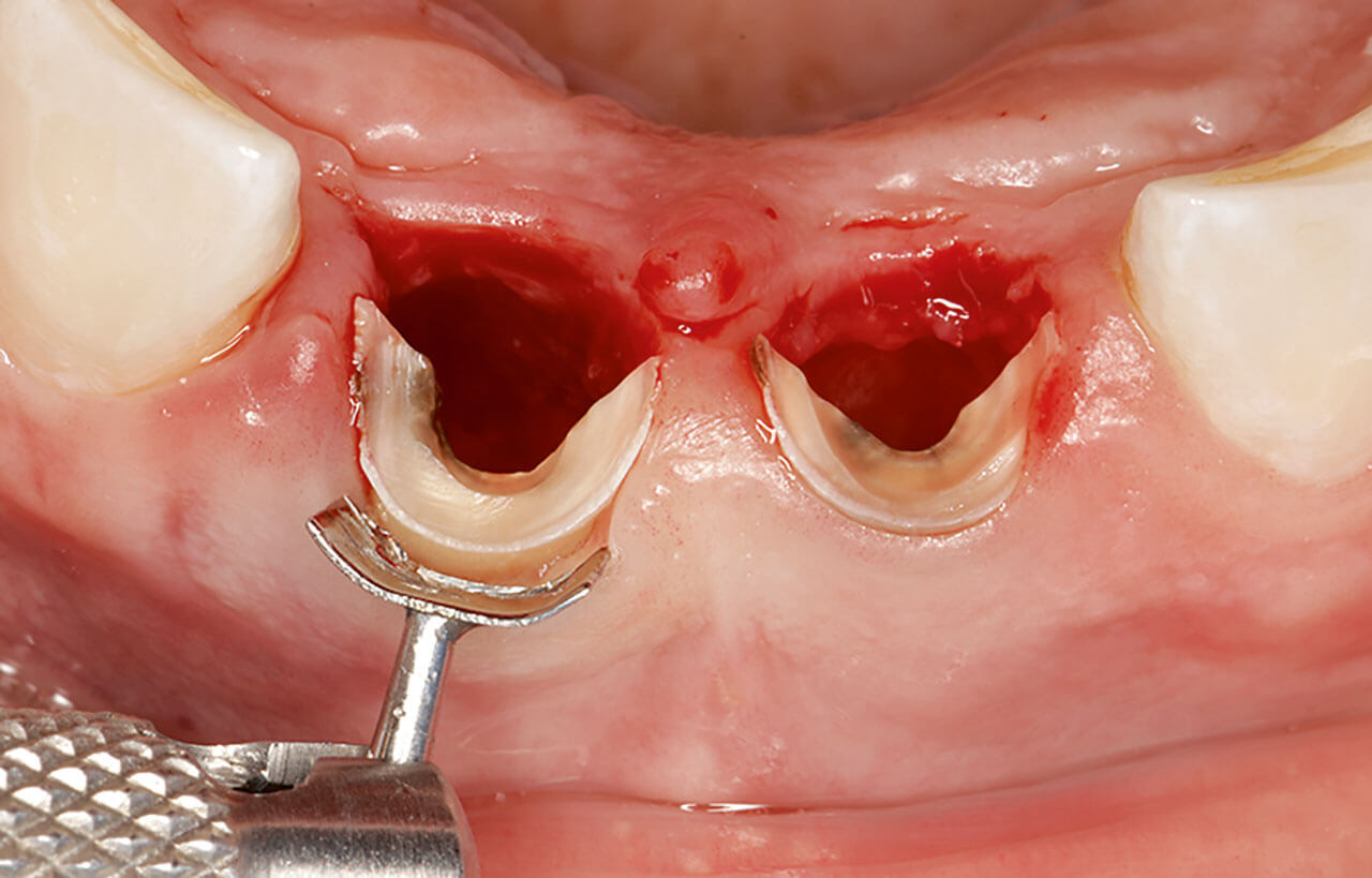 Abb. 11 Zum Einkürzen des Wurzelschilds wird der Gingivarand mit einem Retraktionsinstrument ­abgehalten und geschützt.
