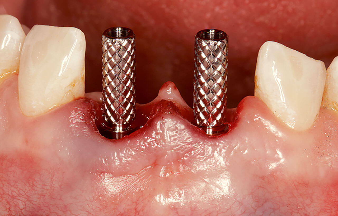 Abb. 13 Befestigung der provisorischen Abutments auf den Implantaten.
