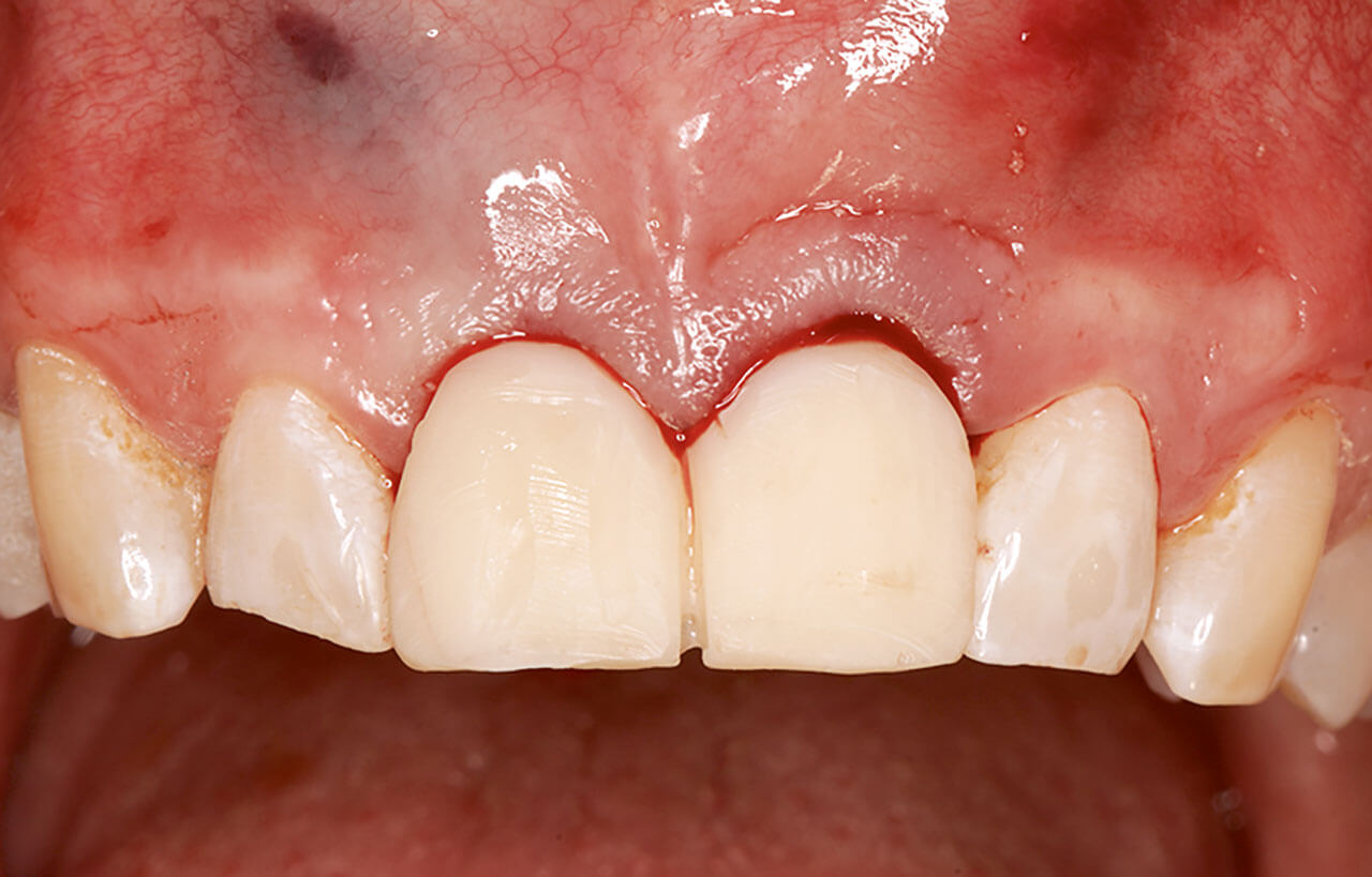 Abb. 14 Die chairside hergestellten, verblockten provisorischen Implantatkronen.