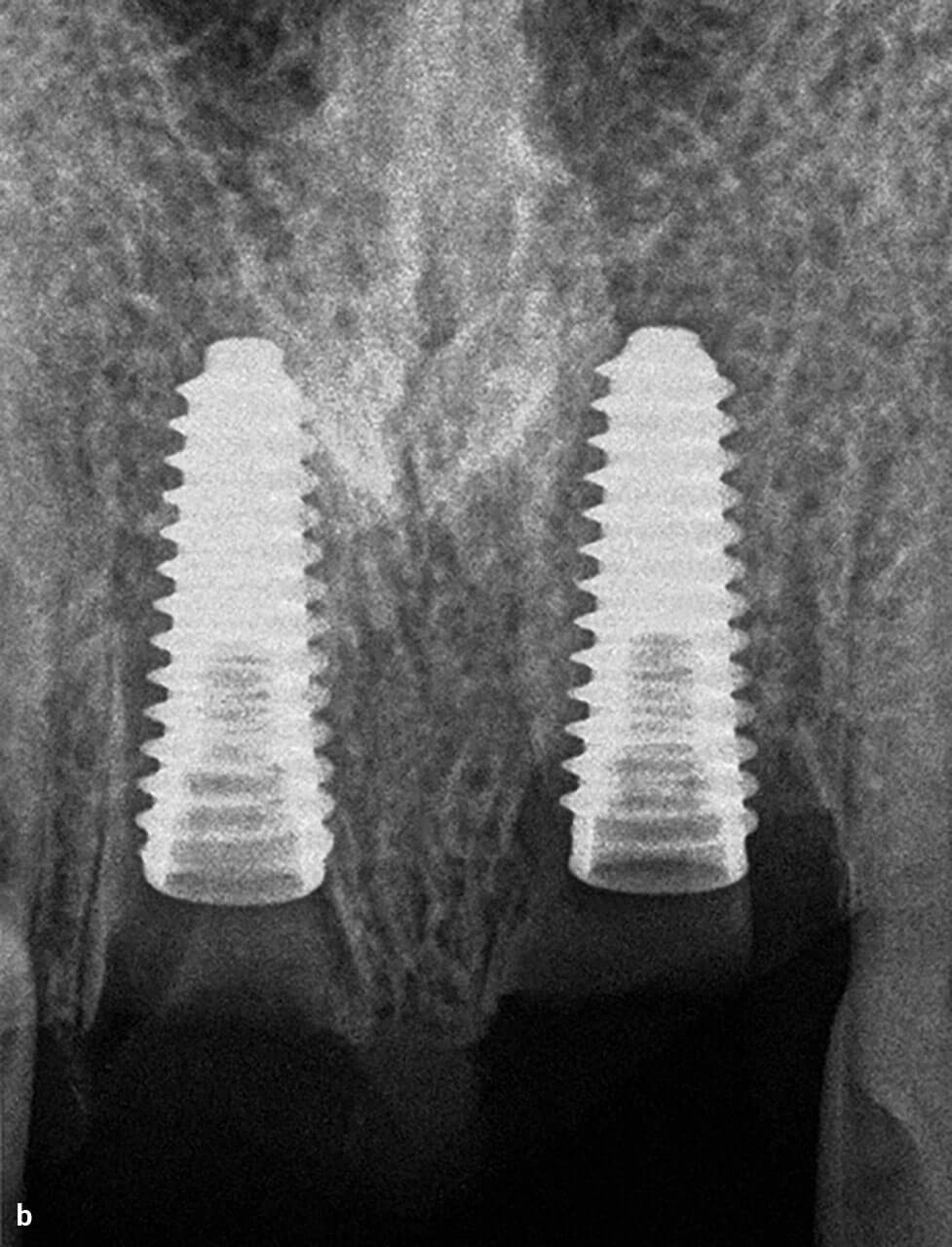 Abb. 16 Röntgenaufnahmen: Die fertig präparierten Socket Shields (a) sowie die neben den Socket Shields inserierten Implantate (b).