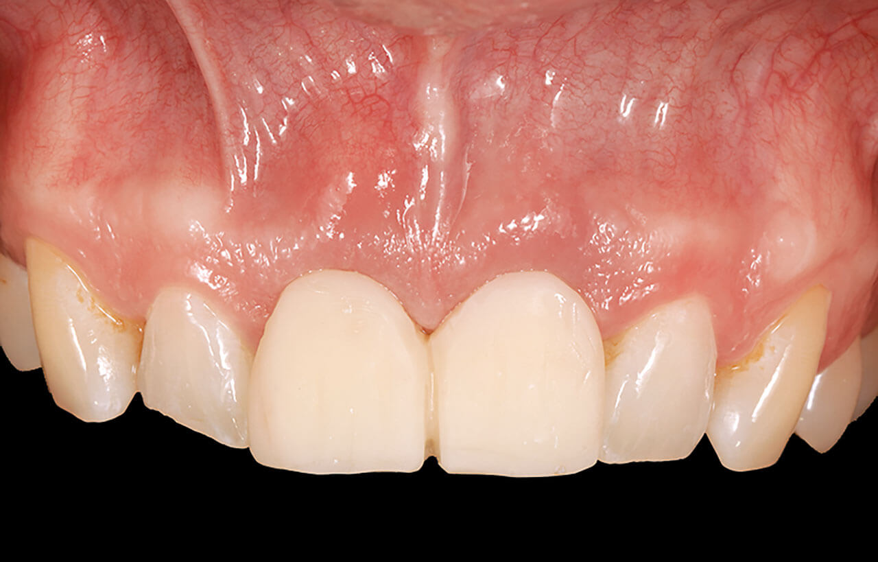 Abb. 17 Situation nach einer Woche: Insgesamt unauffällige Heilung, allerdings ist labial am Implantat 11 eine Schwellung zu beobachten.