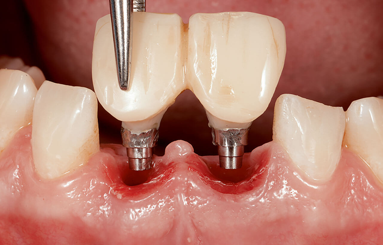 Abb. 21 Situation nach 20 Wochen: Test der Osseointegration (ISQ > 70).