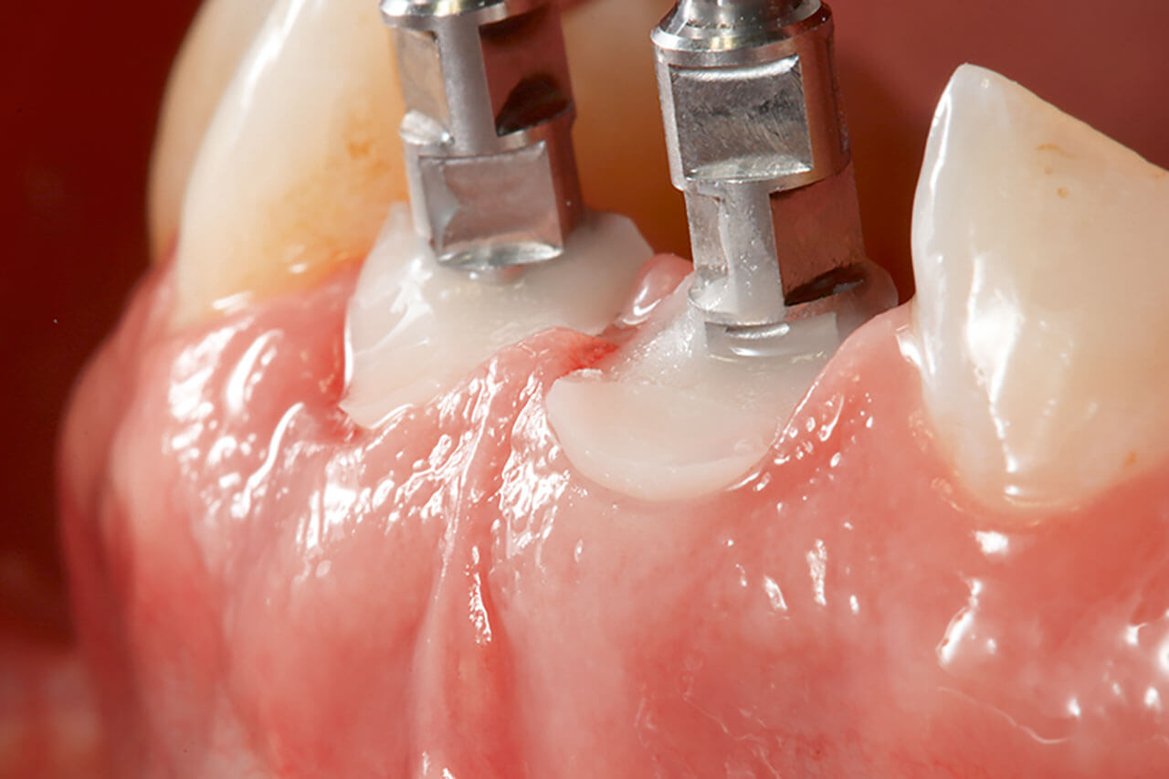 Abb. 25 Die auf den Implantaten fixierten individuellen Abformpfosten.