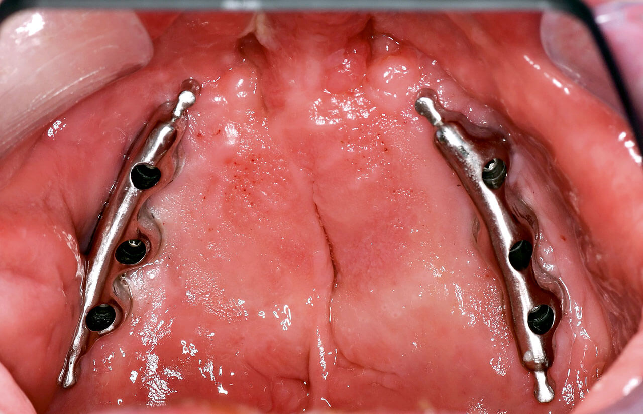 Abb. 16 Implantatgetragene Stegversorgung im Oberkiefer von Patient 2.