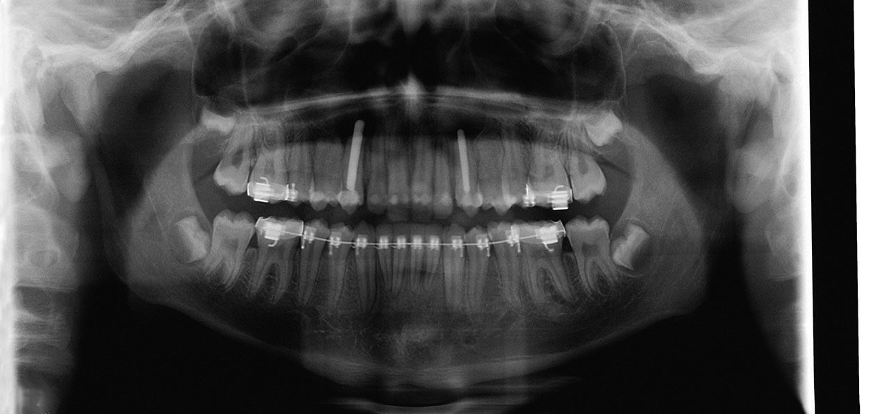 Abb. 9 OPTG post OP: Darstellung der Autotransplantate mit Retropoststiften.