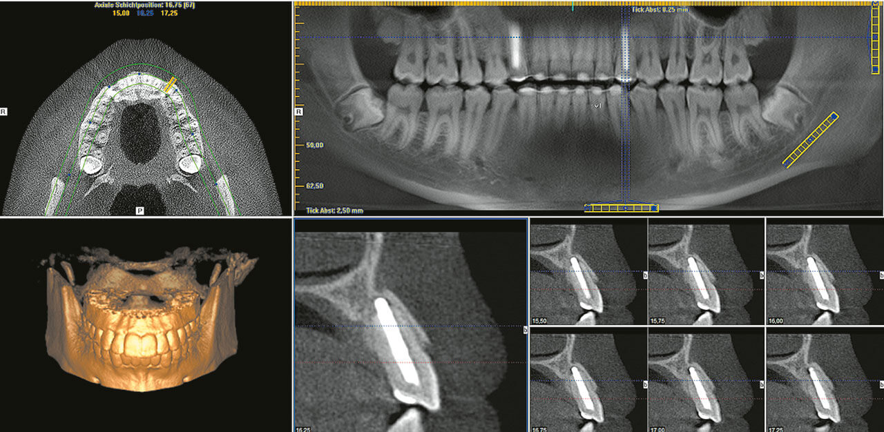 Abb. 12 DVT-Ausschnitt Regio 23 (3 Jahre post OP).