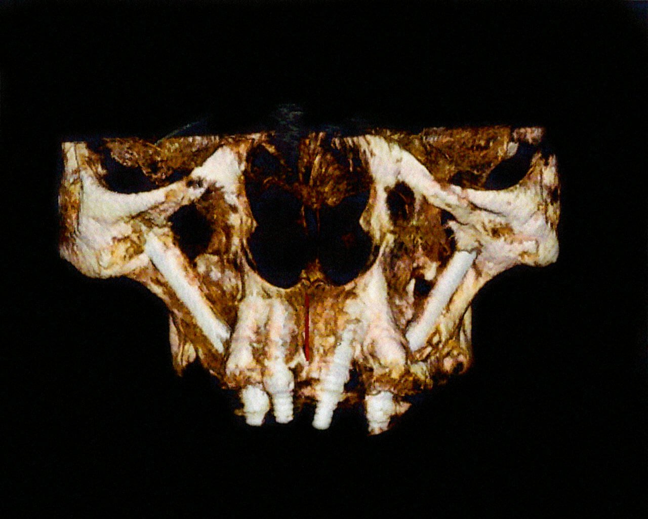 Abb. 10 Postoperative Kontroll-DVT.