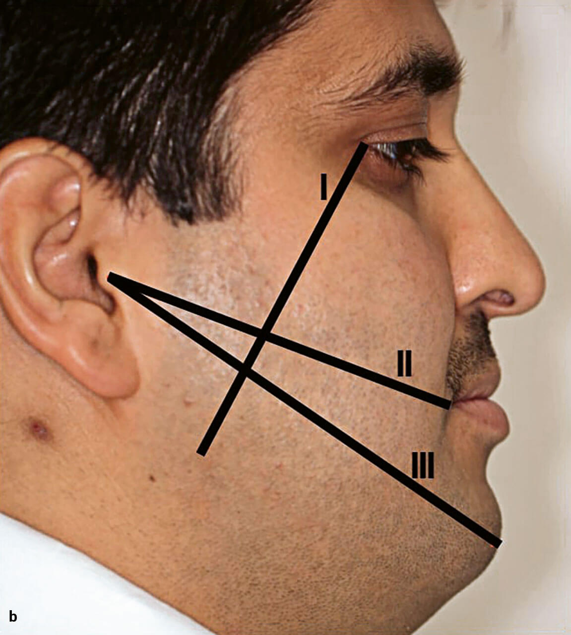 Abb. 13a und b Abstandsmessungen zur Quantifizierung der Schwellung nach Amin und Laskin25. I: Abstand lateraler Augenwinkel – Kieferwinkel, II: Abstand Tragus – Mundwinkel, III: Abstand Tragus – Pogonion.