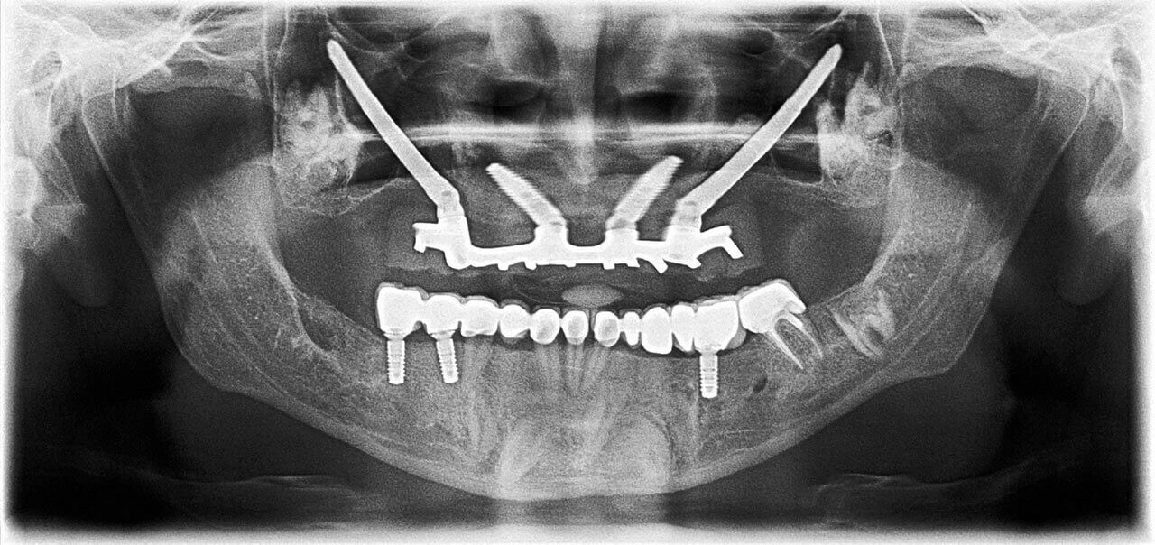 Abb. 5 Postoperative Panoramaschichtaufnahme.