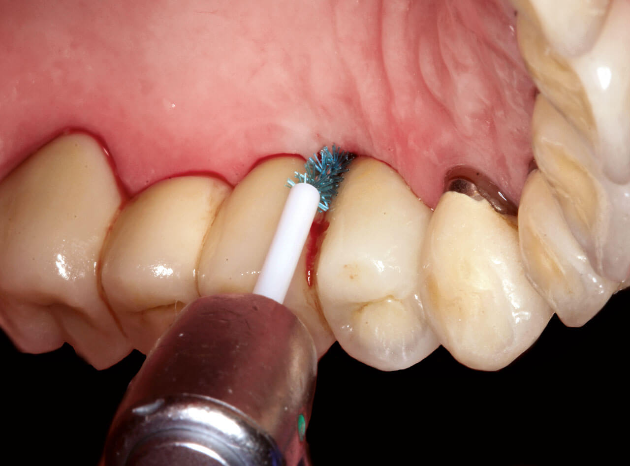 Abb. 8 Mechanische Implantatoberflächendekontamination mit Chitosanbürste.