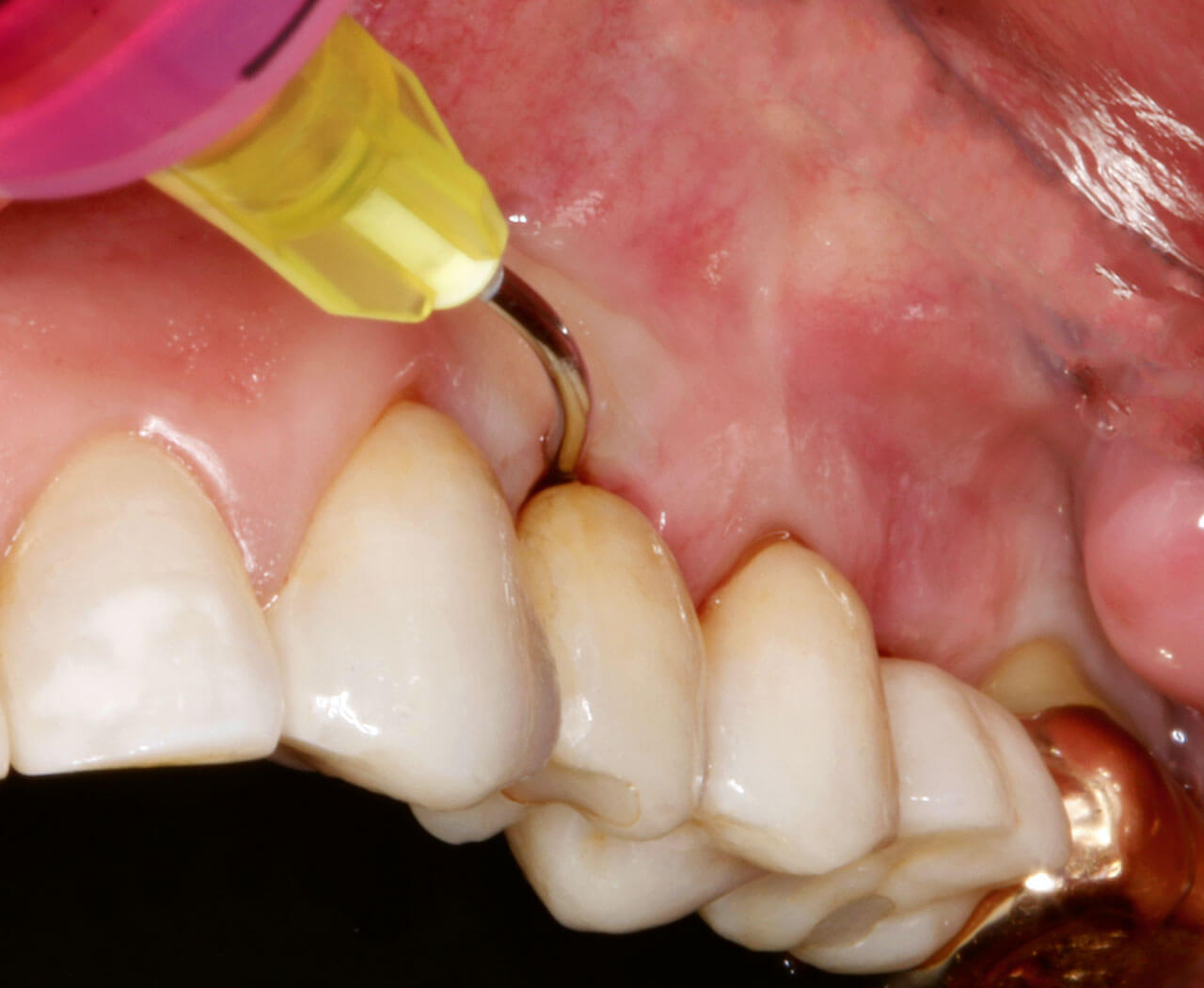Abb. 14 Spülung eines Implantates mittels CHX.