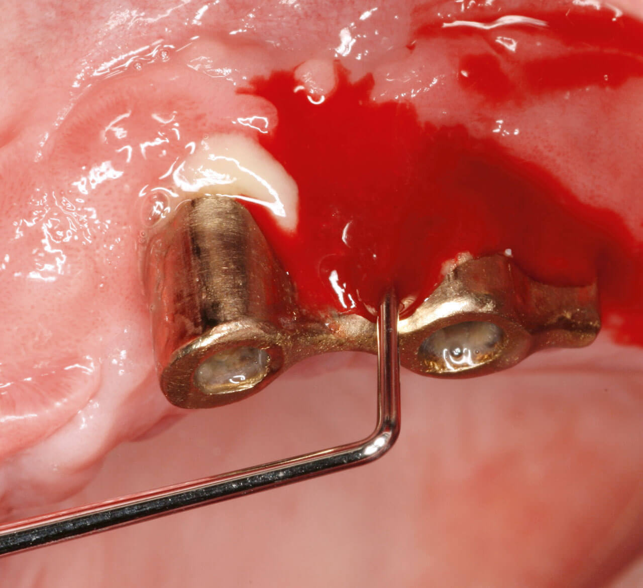 Klinisches Bild von zwei Implantataufbauten im Oberkiefer und einer Parodontalsonde mit Blutung am rechten Implantataufbau und Eiteraustritt am linken Implantataufbau.