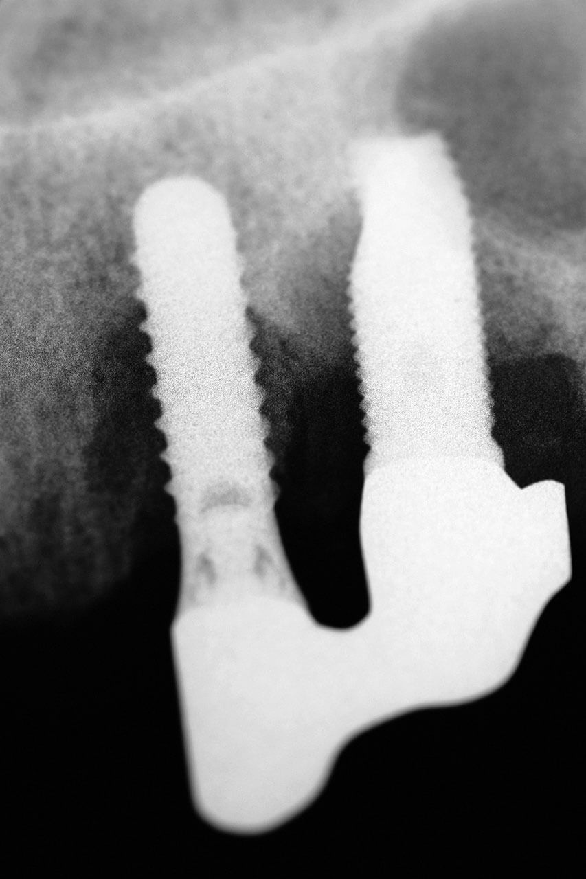 Röntgenbild von zwei Implantaten im Oberkiefer mit verblockten Aufbauten und trichterförmigem Knochenabbau um die Implantate.