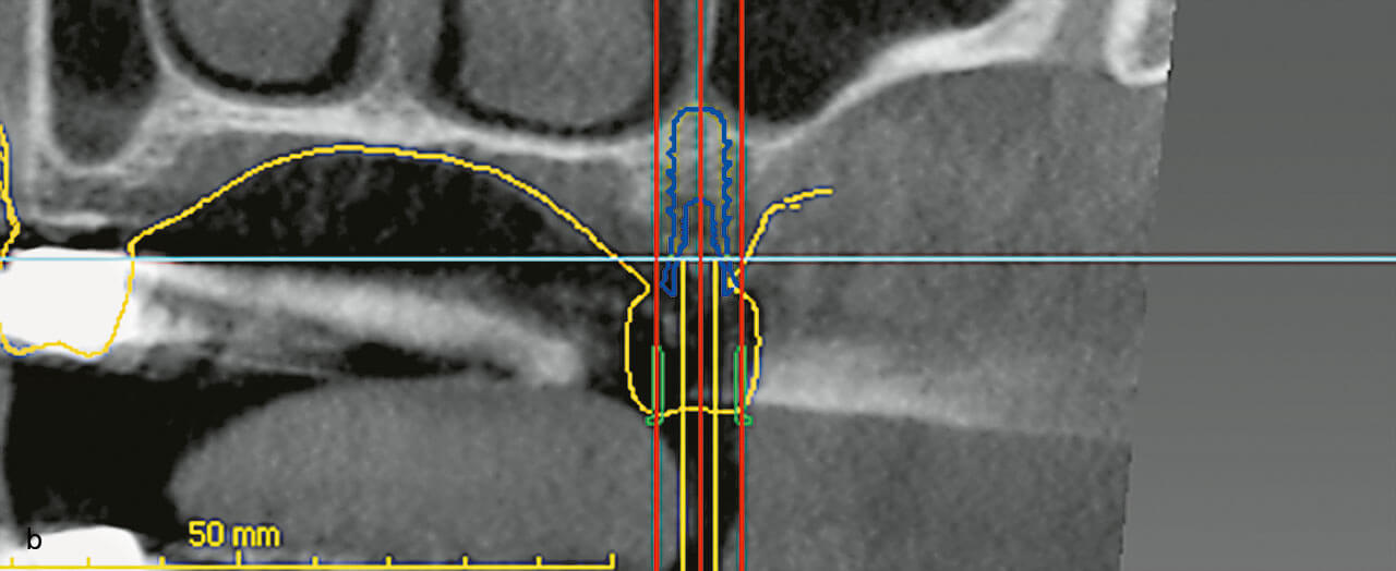 Abb. 7 b Entsprechende präoperative Planungsdaten mit 8-mm-Implantat (blau); intraoperativ wurde der Wechsel auf ein 10-mm-Implantat (Straumann TL RN 4.1 x 10 mm) beschlossen.