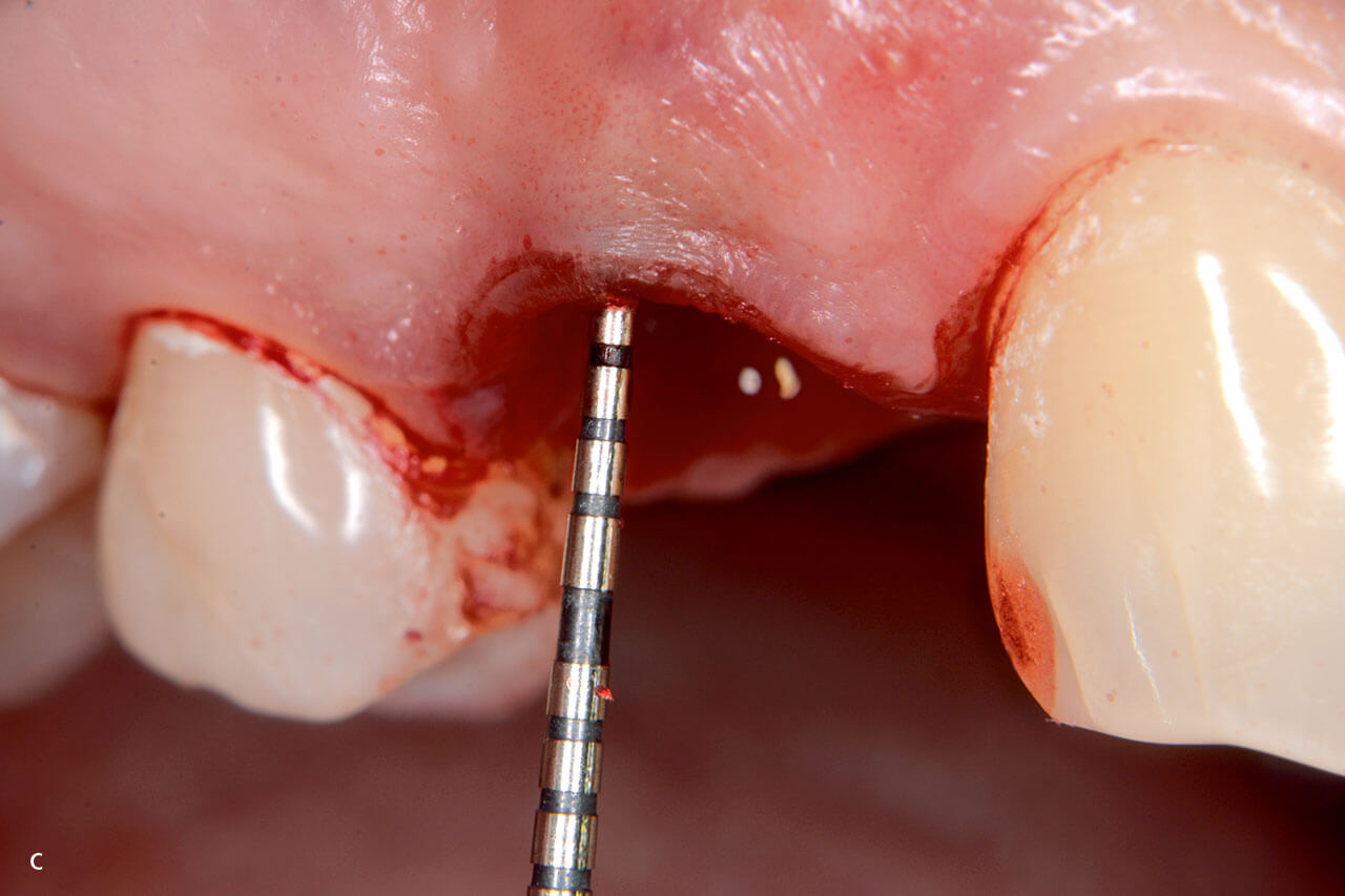 Abb. 1c Repräsentativer Fall eines Zahns 14: Mit einer Parodontalsonde wird die Unversehrtheit des bukkalen Knochens überprüft.