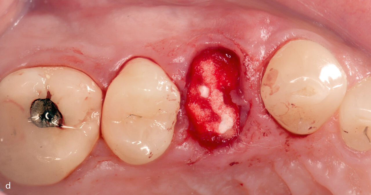 Abb. 1d Repräsentativer Fall eines Zahns 14: Ein Schwamm aus bovinem Kollagen wird wie ein Stopfen in der Alveolenöffnung platziert.