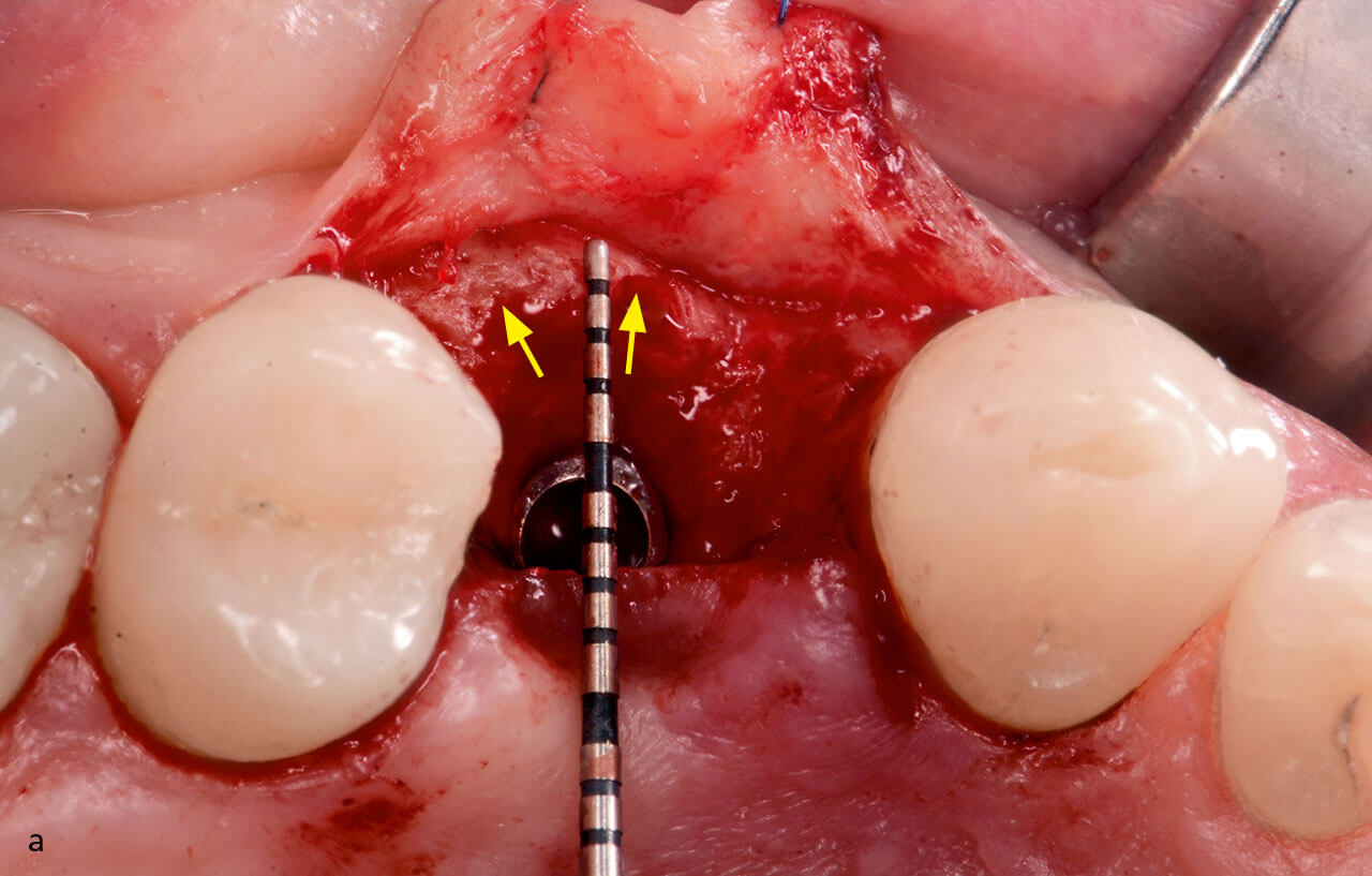 Abb. 6a und b Messung der bukkalen Knochendicke: a) unmittelbar nach der Implantatsetzung sowie b) bei der Freilegungsoperation 3 Monate nach der Implantation.