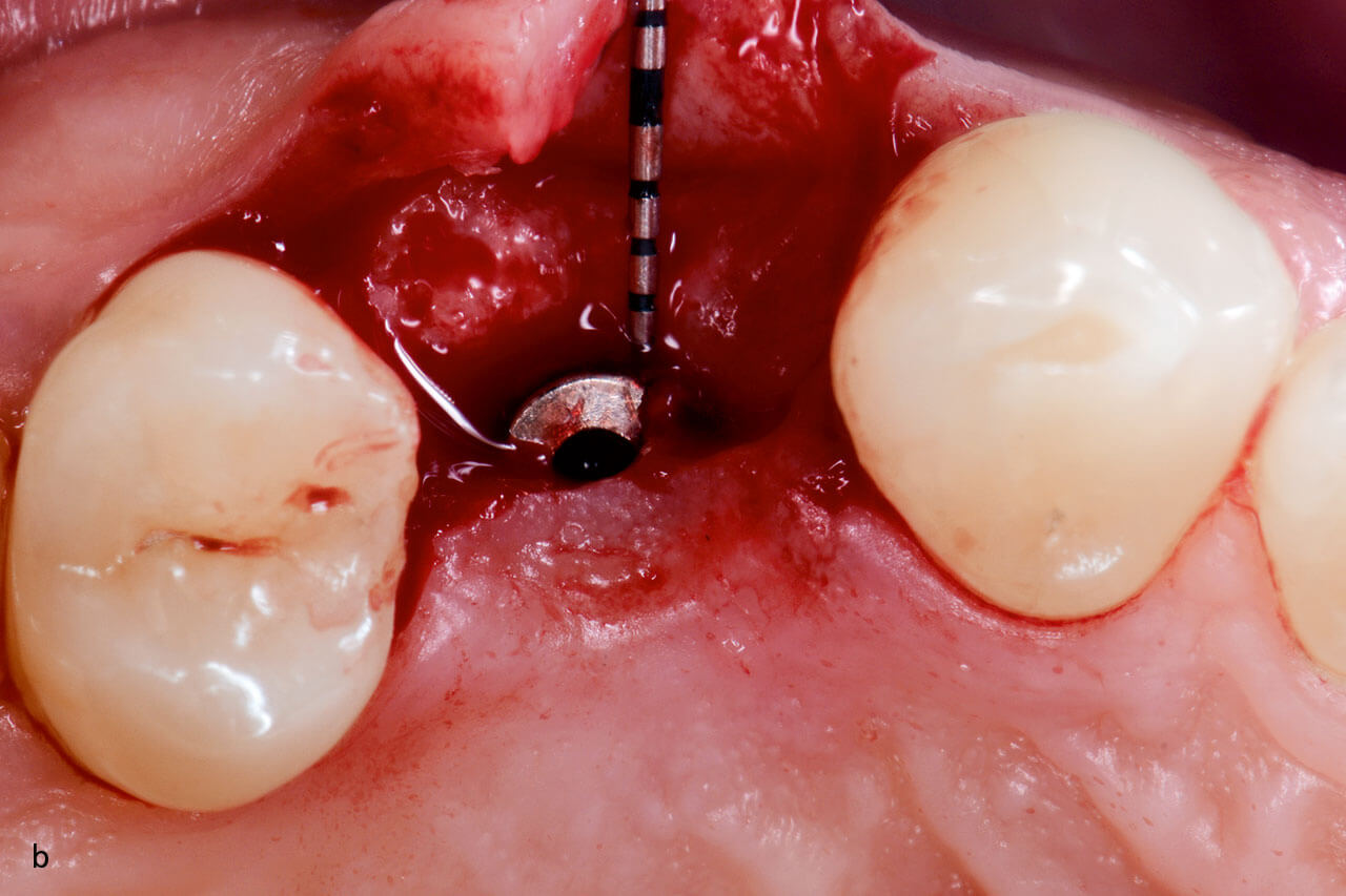 Abb. 6a und b Messung der bukkalen Knochendicke: a) unmittelbar nach der Implantatsetzung sowie b) bei der Freilegungsoperation 3 Monate nach der Implantation.