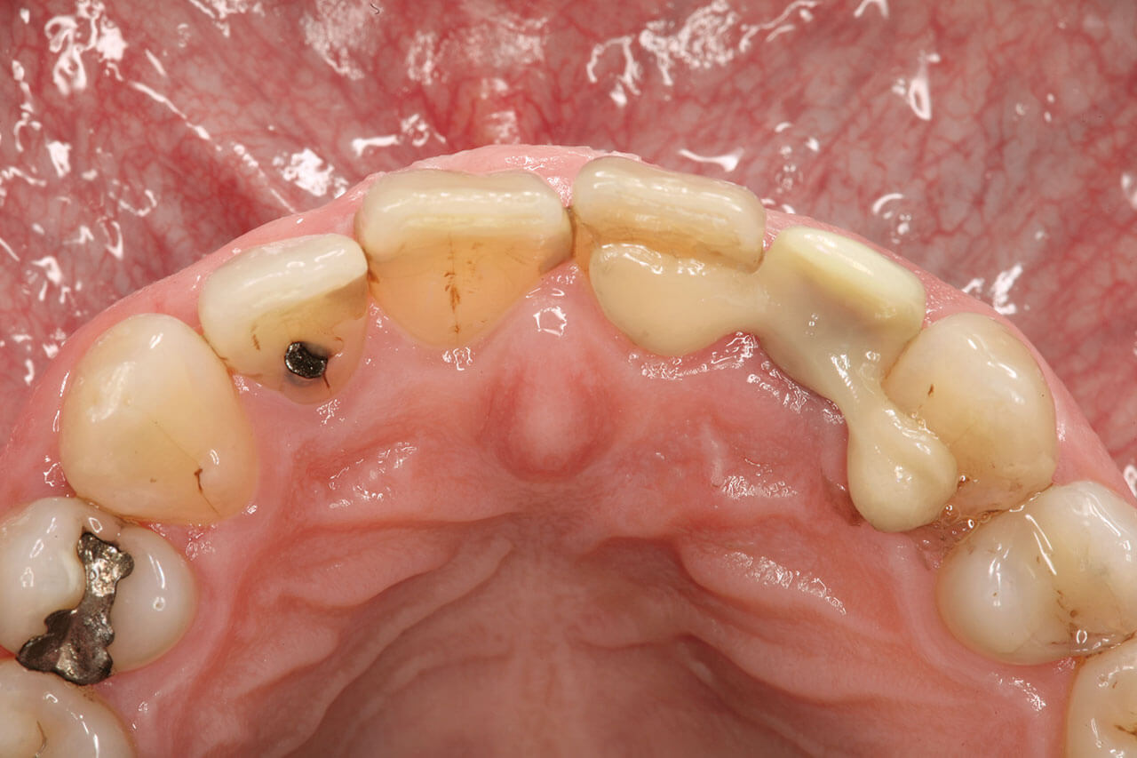 Abb. 17 Provisorische Adhäsivbrücke mit Zirkonoxidgerüst zum Ersatz von Zahn 22 nach Implantation (Inzisalansicht).