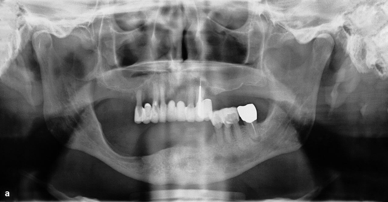 Abb. 1a Präoperative Panoramaschichtaufnahme.