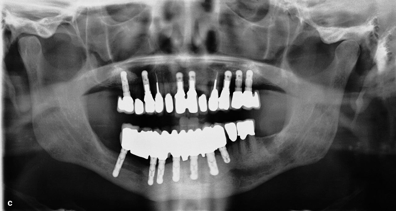 Abb. 1c Definitive prothetische Versorgung.