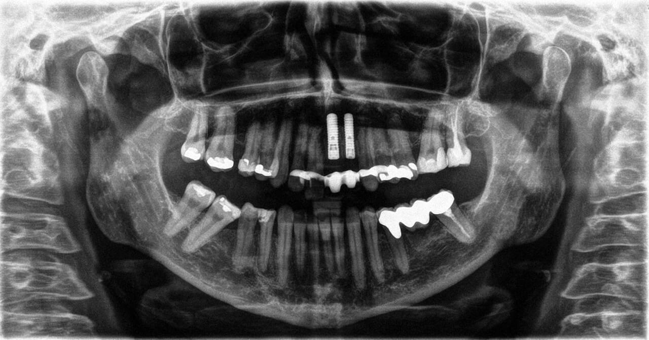 Abb. 2 OPG nach Insertion von zwei Implantaten im anterioren Oberkiefer, provisorische Versorgung mithilfe einer Klebebrücke.