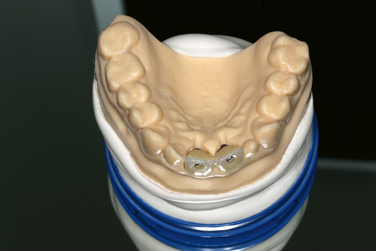Abb. 11 Auf dem Modell fertiggestellte Kronen mit den vestibulär liegenden Schraubenkanälen.