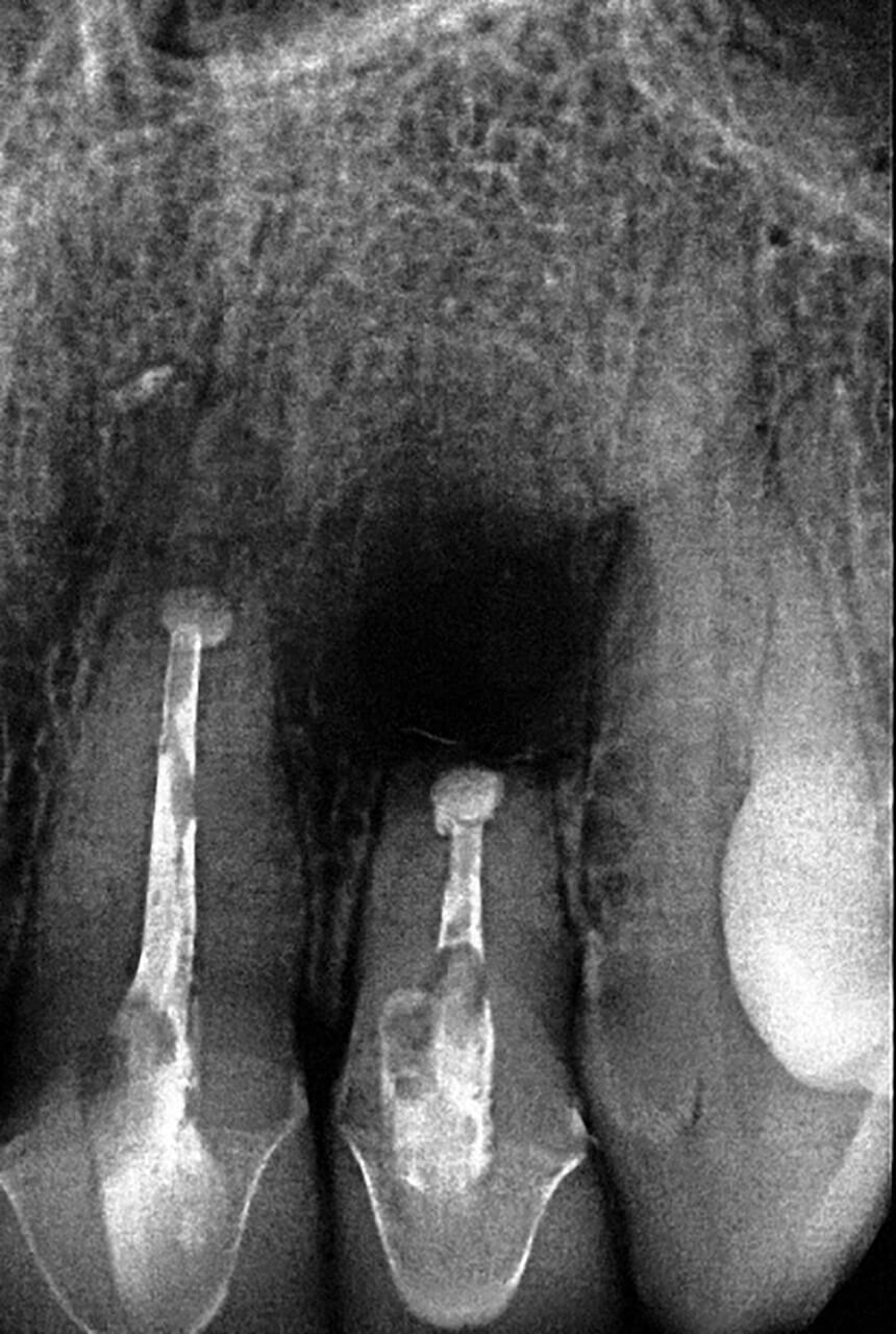 Abb. 15 Im Zahnfilm wird das Ausmaß der Resorption, insbesondere beim Zahn 22, noch offensichtlicher.