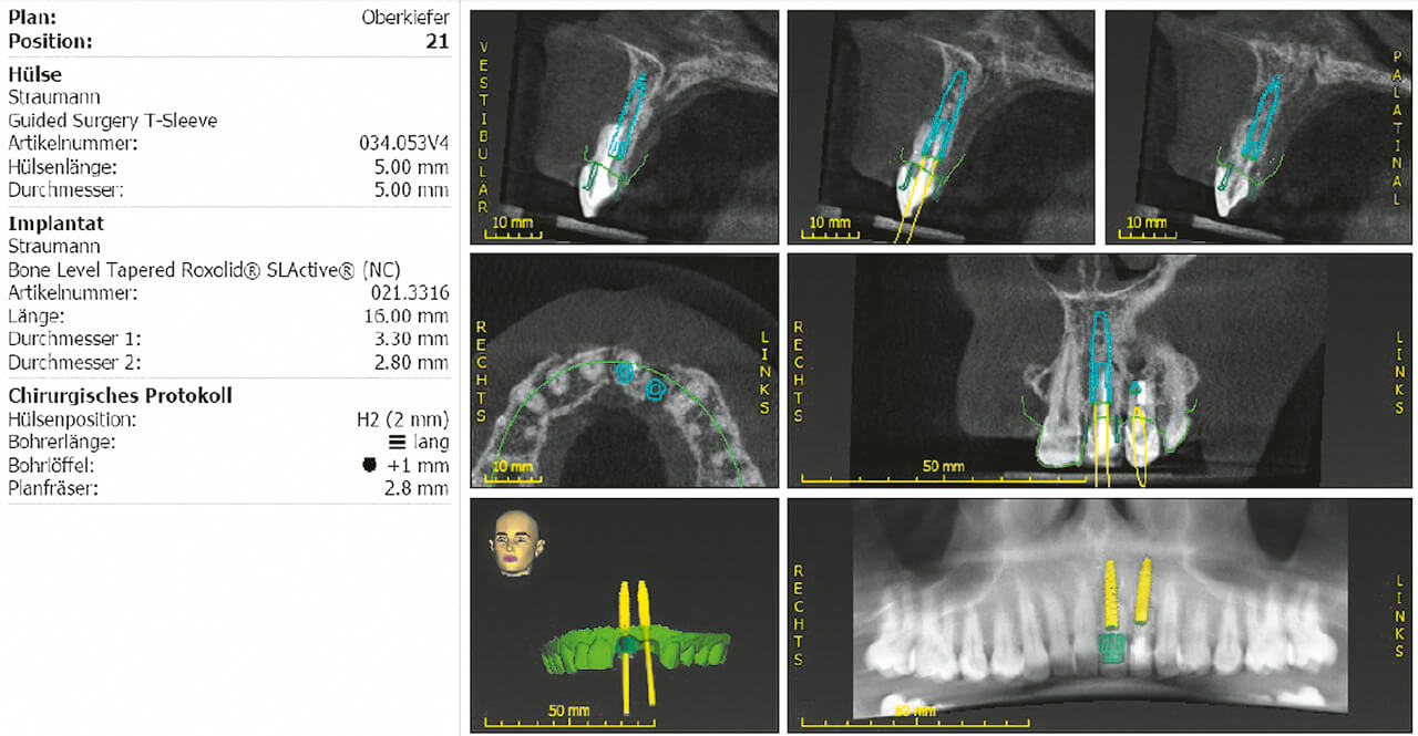 Abb. 17 Planung der Implantatpositionen zum Ersatz der Zähne 21 und 22.